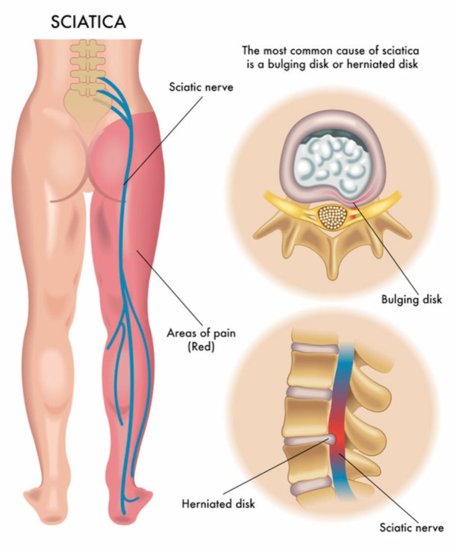El Dolor De Ciatica Masaje Tratamiento Masaje Para Dolor De