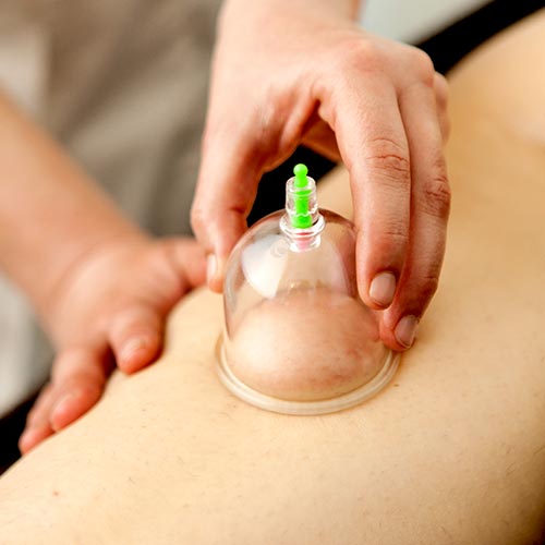 Cupping Masajes Con Ventosas Terapia Ventosas Dolor De Espalda